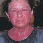 Before Acupressure Allergy Relief